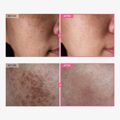 🌟 LOVILDS™ Arbutin 7% + Tranexamic Acid 4% Brightening Cream | Targets Dark Spots, Freckles, Blemishes & Pigmentation